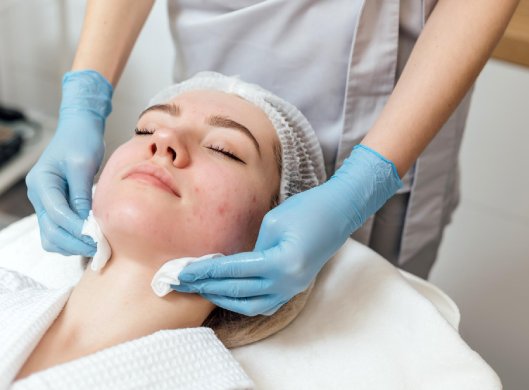 علاج حب الشباب